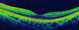 OCTの画像