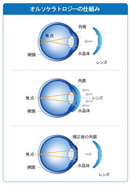 オルソケラトロジーの仕組み