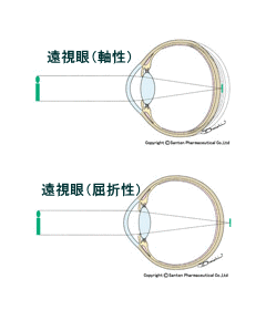 遠視眼