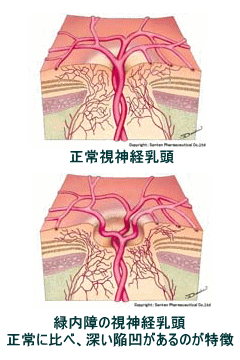 正常な視神経乳頭と緑内障の視神経乳頭